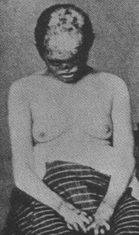 porphyria2.jpg